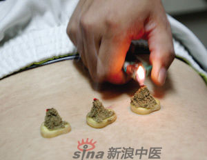 灸法的種類  你知道多少？